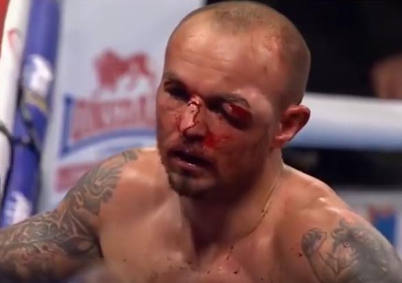 Kevin Mitchell wears an ugly eye injury following his war with Jorge Linares